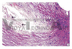 The slice of aorta atherosis